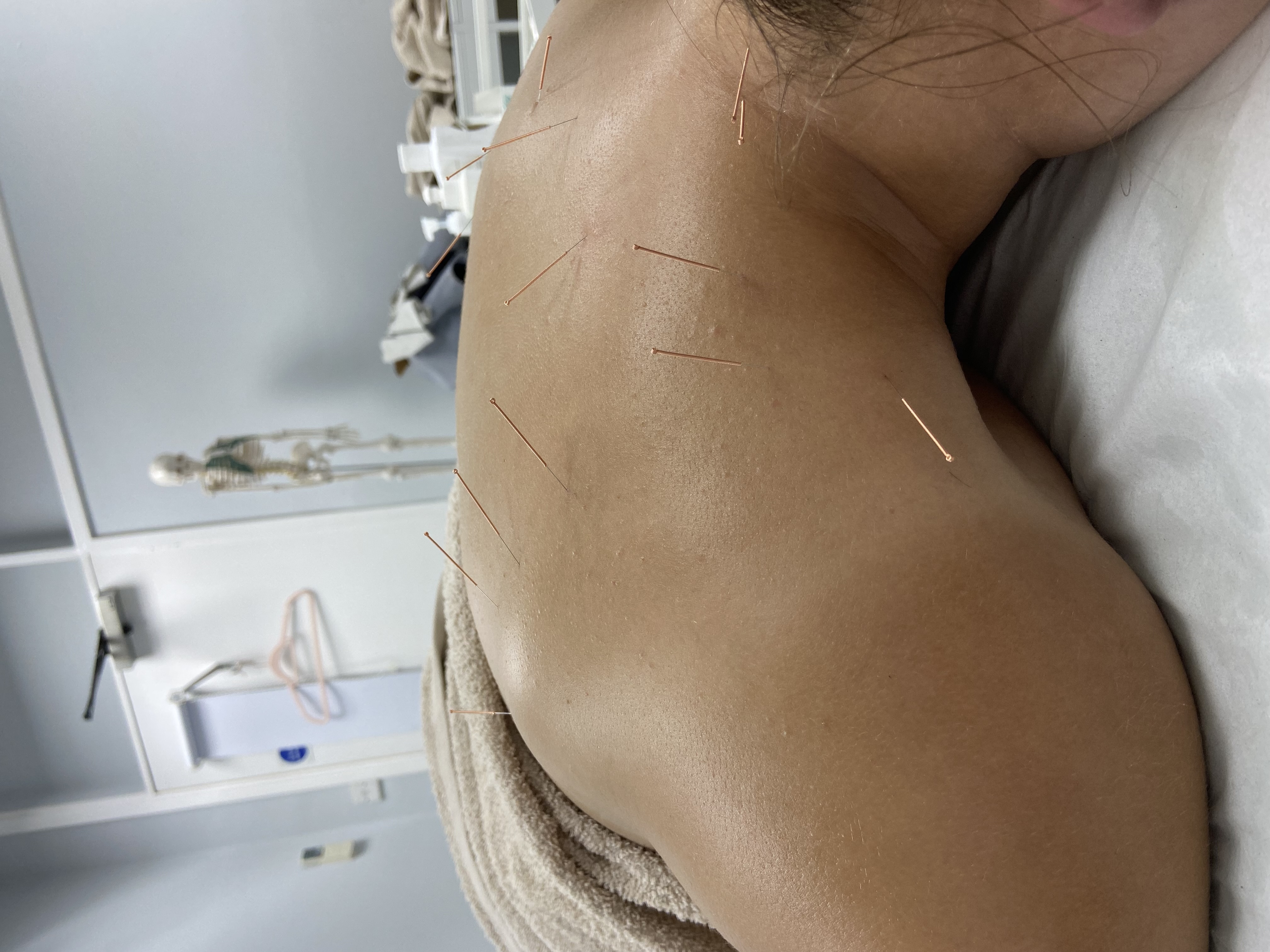 Medical Acupuncture treatment